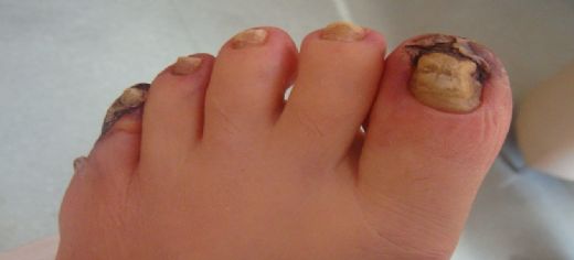 Diyabet Komplikasyonları Nelerdir?